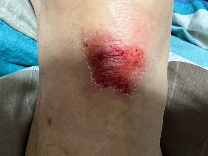 膝の擦過傷１.jpg